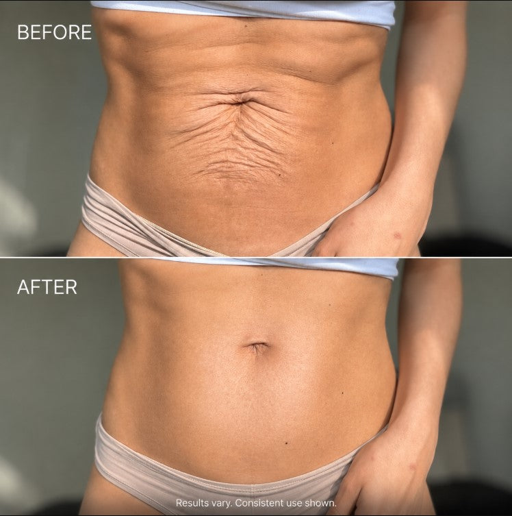 Firm Loose Skin With The FirmaSculpt™ 4-in-1